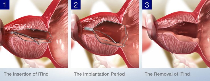 Illustration of the iTind device positioned in the prostatic urethra